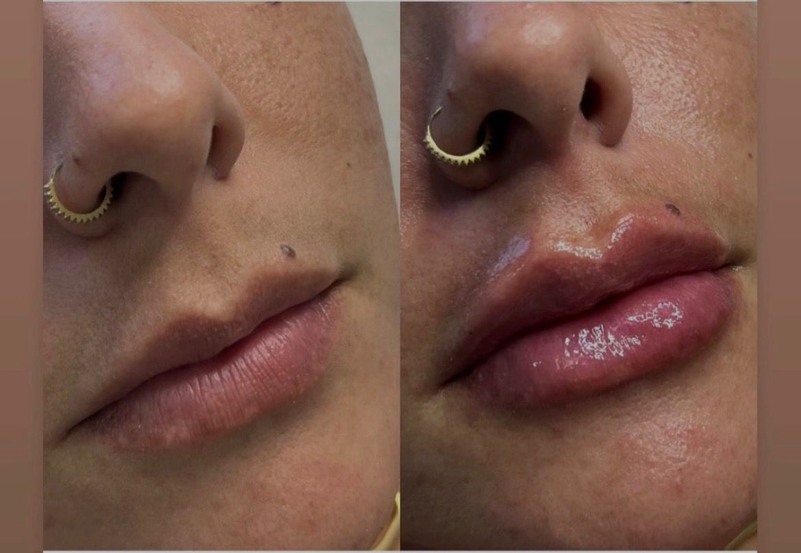 Preenchimento Labial